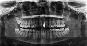 Dental bugs could give you a heart attack!