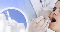 10 facts about dental sealants