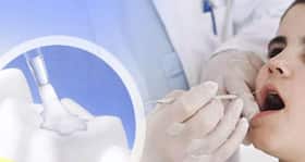 10 facts about dental sealants