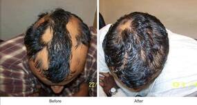 Patchy hair loss - homeopathy to the rescue!