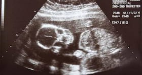 Now a low cost ultra low cost scanner that detects foetal defects