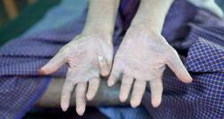 World Leprosy Day -- challenges and advancements in Leprosy eradication