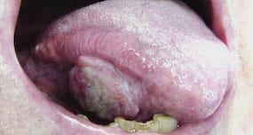 Oral cancer: Symptoms, diagnosis and treatment