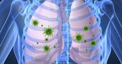 Understanding pneumonia - causes, symptoms,vaccine, prevention, treatment