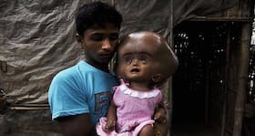 Baby Roona Begum's hydrocephalus - what is this condition?