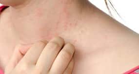 Tips to deal with an itchy skin rash