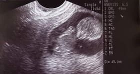 Does autism begin in the womb?