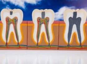 Understanding how decay destroys your teeth