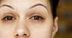Symptoms of viral conjunctivitis include watery, red eyes with prickly sensation and pain