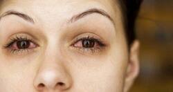 Symptoms of viral conjunctivitis include watery, red eyes with prickly sensation and pain