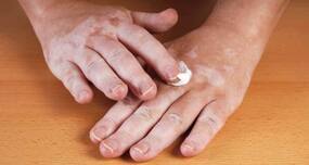 Can vitiligo be treated?