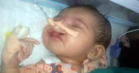 Baby girl with cleft lip abandoned at G.B. Pant hospital