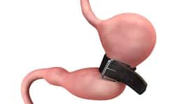 Bariatric surgery - a new hope for obese diabetics