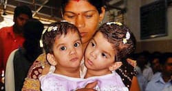 Betul's conjoined twins: Aradhana passes away after heart attack