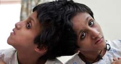 Can Bihar's conjoined twins be separated? SC asks health ministry