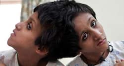 Bihar's conjoined twins: Family undecided on surgery