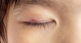 Blepharitis – causes, symptoms, diagnosis, treatment and prevention
