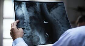 Bone Cancer : हड्डी का कैंसर, लक्षण, कारण और शुरुआती निदान दिलाए सर्जरी से छुटकारा