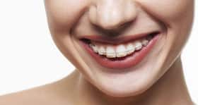 Braces or orthodontic treatment -- what you need to know before getting them
