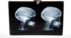 17-year-old boy comes out of a coma after major head accident
