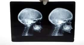 World Cancer Day 2012: Imaging technique which can diagnose brain cancer without invasive surgery!