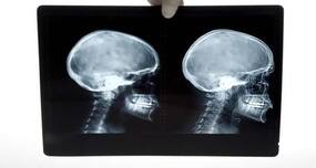 World Cancer Day 2012: Imaging technique which can diagnose brain cancer without invasive surgery!