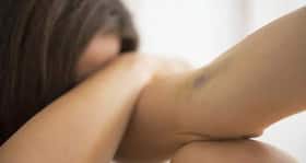 5 causes for bruises on your body