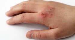 Skin burns – types, treatment, complication, aftercare