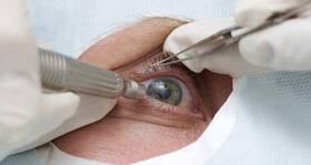 Cataracts – all you need to know