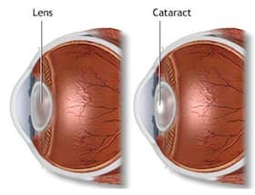 Cataract surgeries -- understanding the different types
