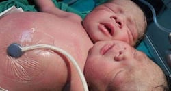 Two heads, one body - Conjoined twins delivered at Sonepat