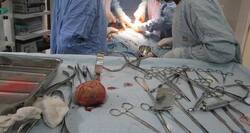 Docs remove cricket ball sized stone from man's bladder!