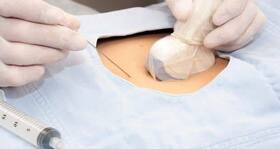 Epidural anaesthesia for painless labour -- what is it?