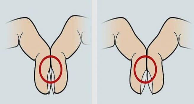 finger clubbing test for lung cancer