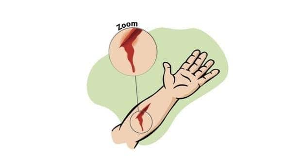 How to deal with common medical emergencies like cuts, wounds, burns ...