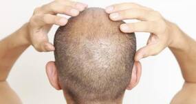 Is the FUE hair transplant method useful? (Hair loss query of the day)