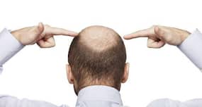 Are your hormones causing your hair loss?