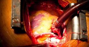 Did Lilavati Hospital's gross negligence leave a heart surgery patient with leg burn injuries?