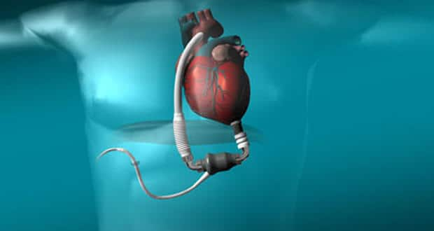 Heartmate II - a new hope for terminal heart patients | TheHealthSite.com