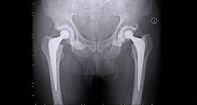 Minimally invasive joint replacements and their advantages over conventional replacements Minimally invasive joint replacements and their advantages over conventional replacements