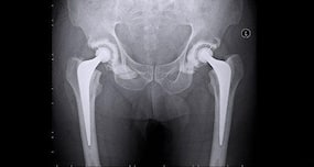 Minimally invasive joint replacements and their advantages over conventional replacements
