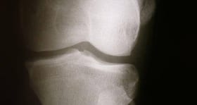 Is physical therapy a better solution for knee pain than surgery?