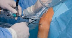 Cells from your nose may hold the secret to repairing your damaged knees
