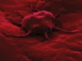 Chronic Myeloid Leukemia or blood cancer in adults - causes, symptoms, diagnosis, treatment and prognosis