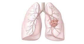 Curcumin could slow down progression of lung lining cancer