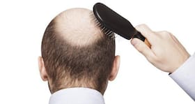 What is male pattern baldness? (Hair loss Query) What is male pattern baldness? (Hair loss Query)