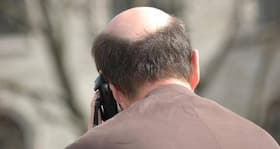 Do you have male pattern baldness?