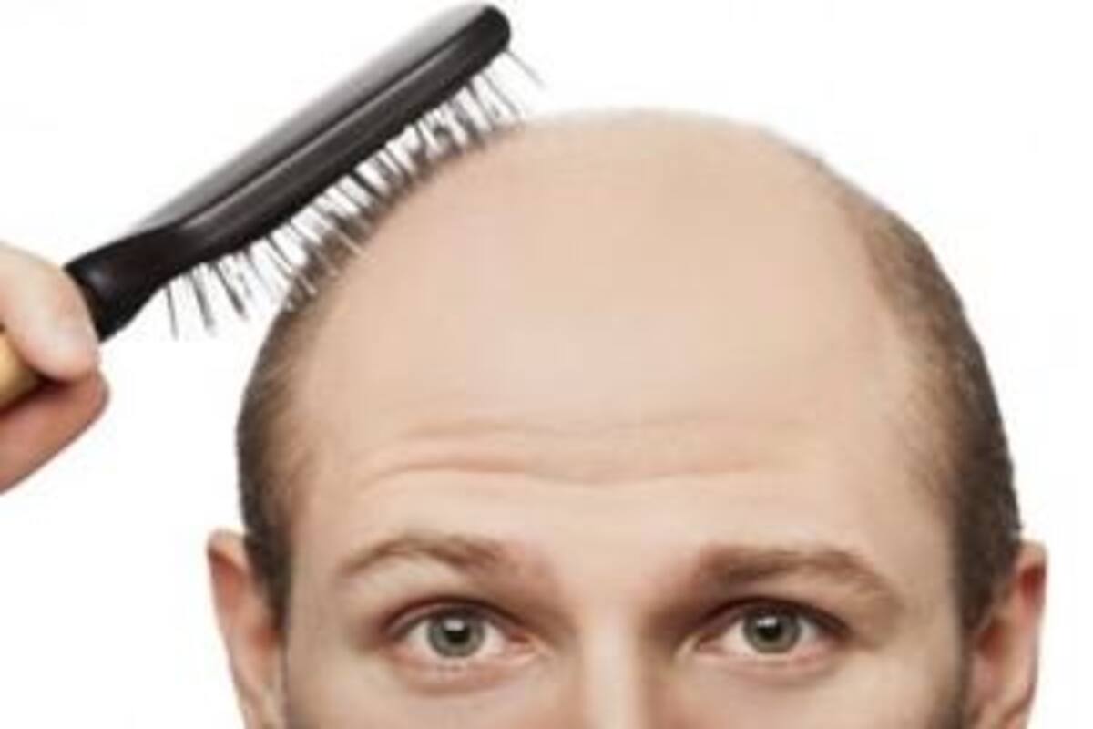 Can My Hair Loss Be Permanently Reversed With The Surgical Options
