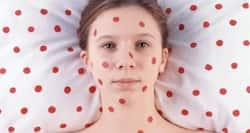 Now a drug to protect unvaccinated people from measles