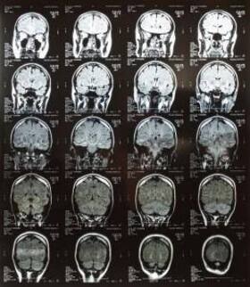 World MS Day 2012: AIIMS to set up database World MS Day 2012: AIIMS to set up database